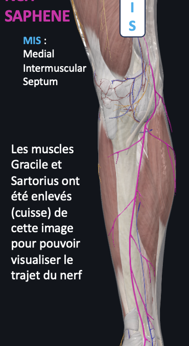 Opération pour une compression du nerf SAPHÈNE