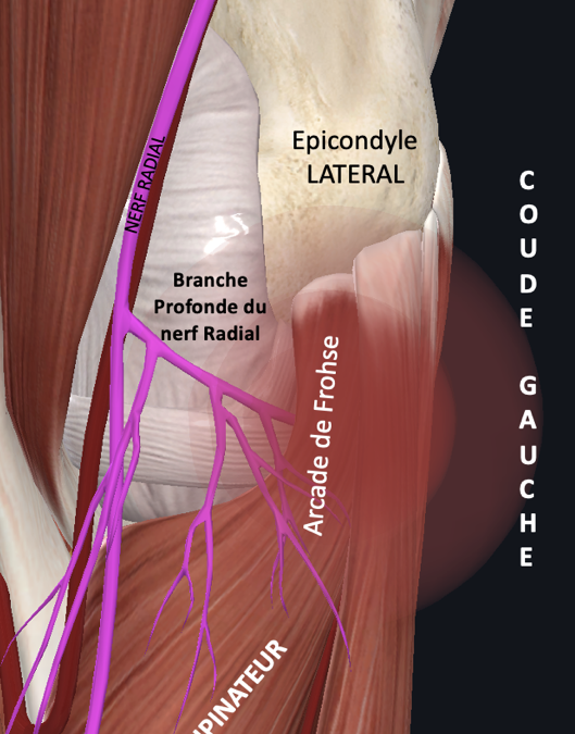 Syndrome du Tunnel Radial (STR)