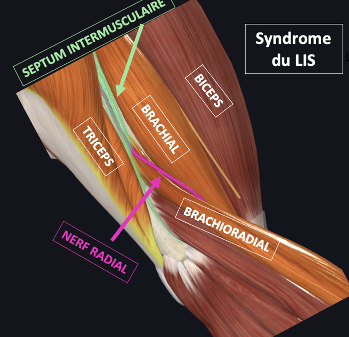 Syndrome du LIS